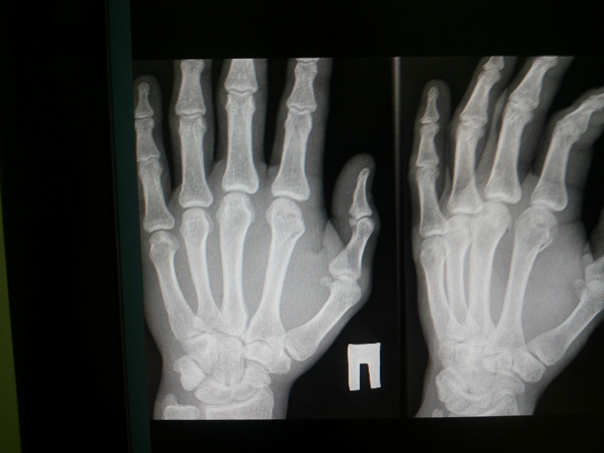x-ray picture hand free photo