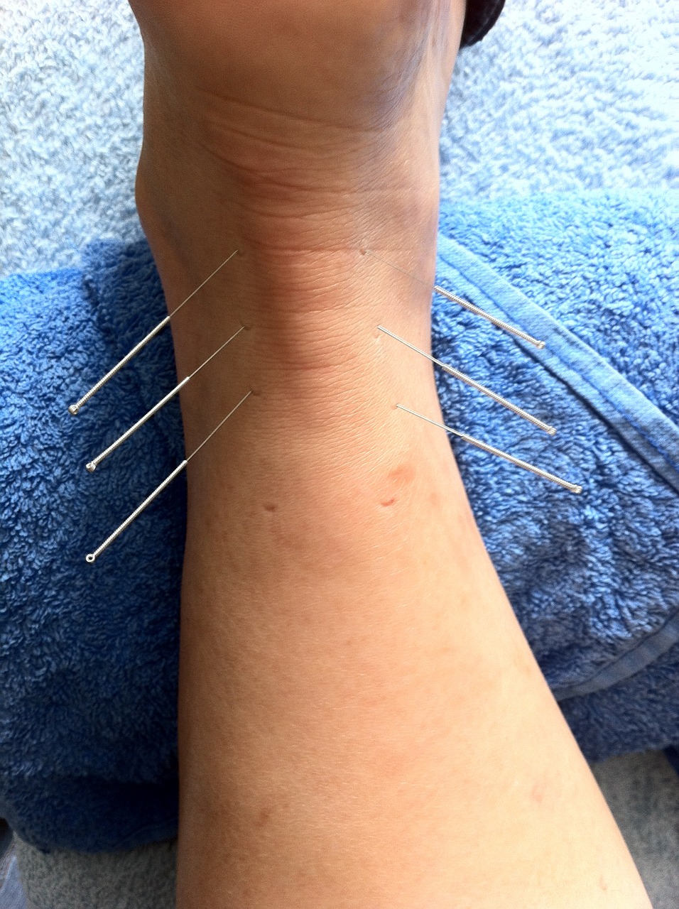 acupuncture sport injury sports massage free photo