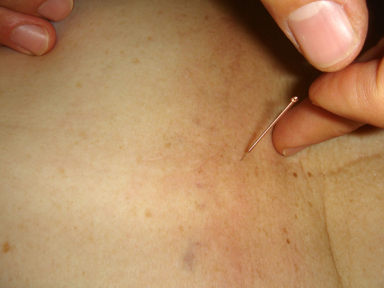 acupuncture needle acupuncture needle free photo