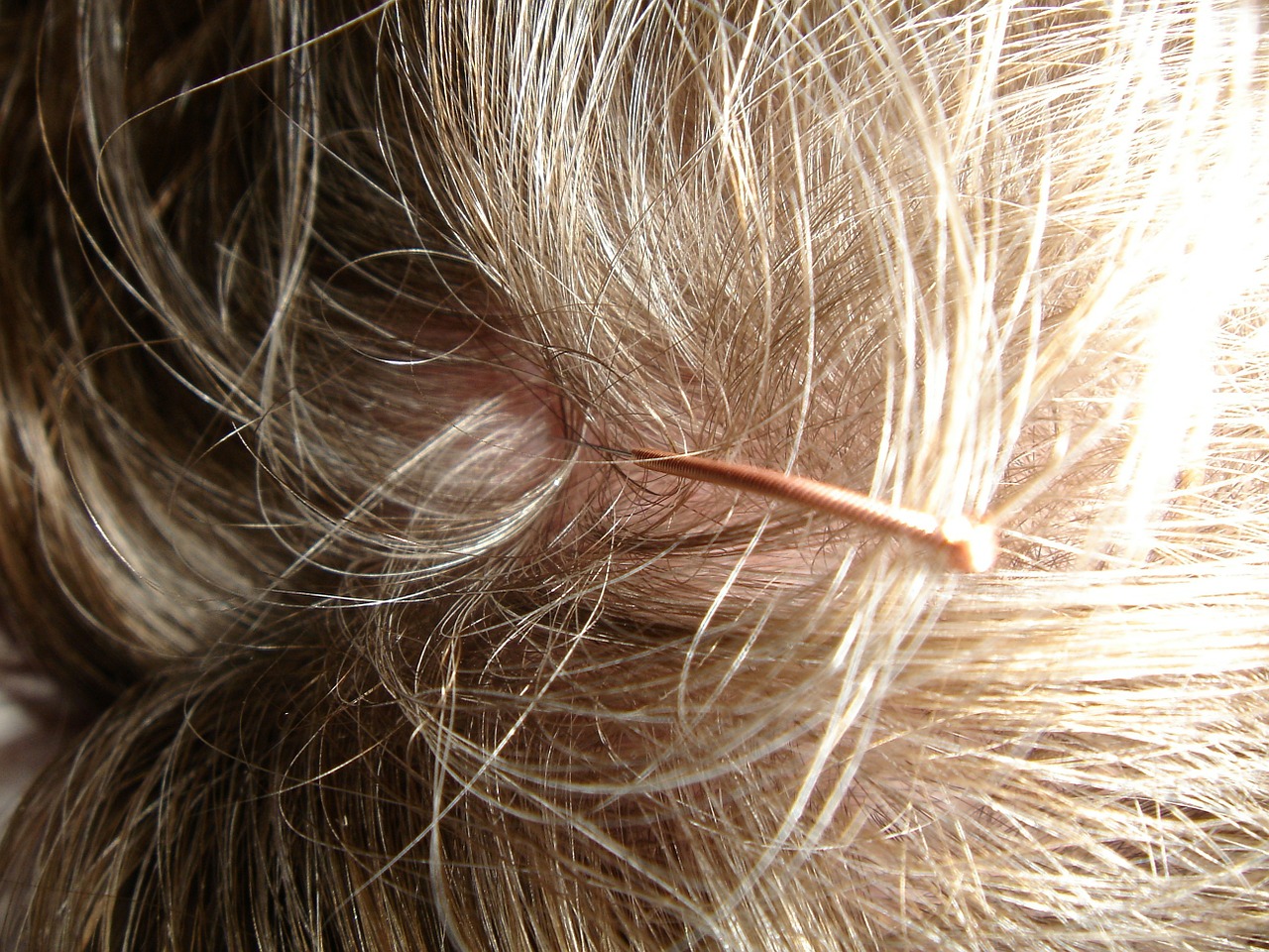 acupuncture acupuncture needle scalp free photo