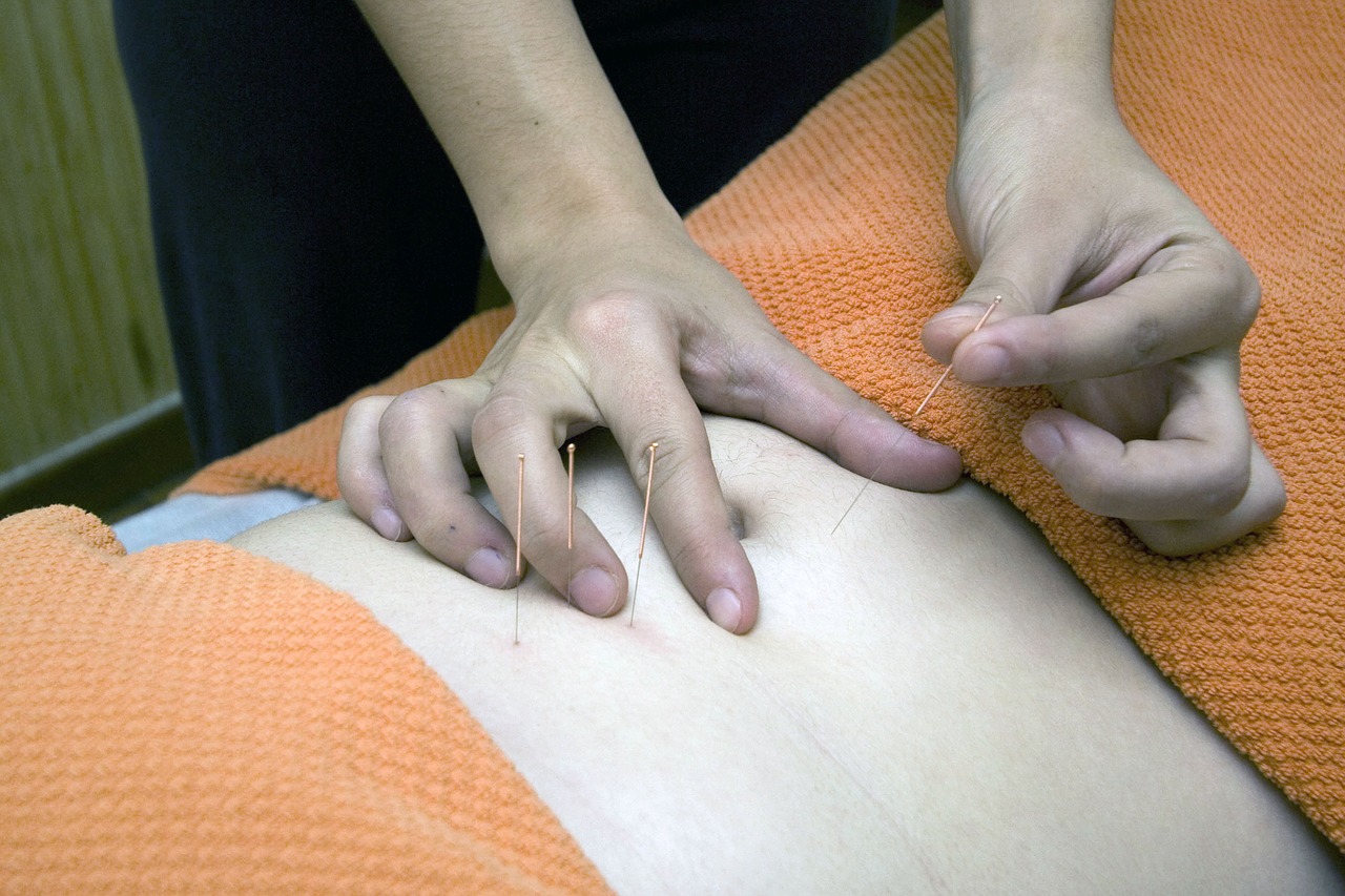 Acupuncture, physiotherapy, wellness, relax, bless you - free image from  needpix.com