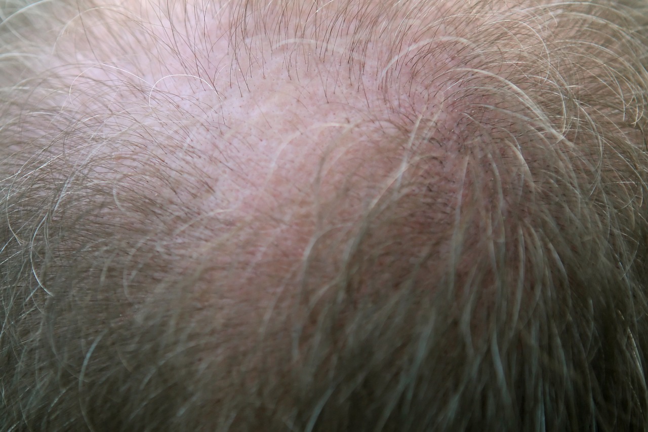 adult bald balding free photo
