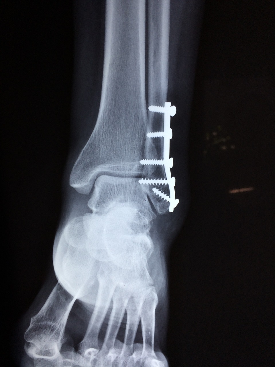 ankle fracture foot free photo
