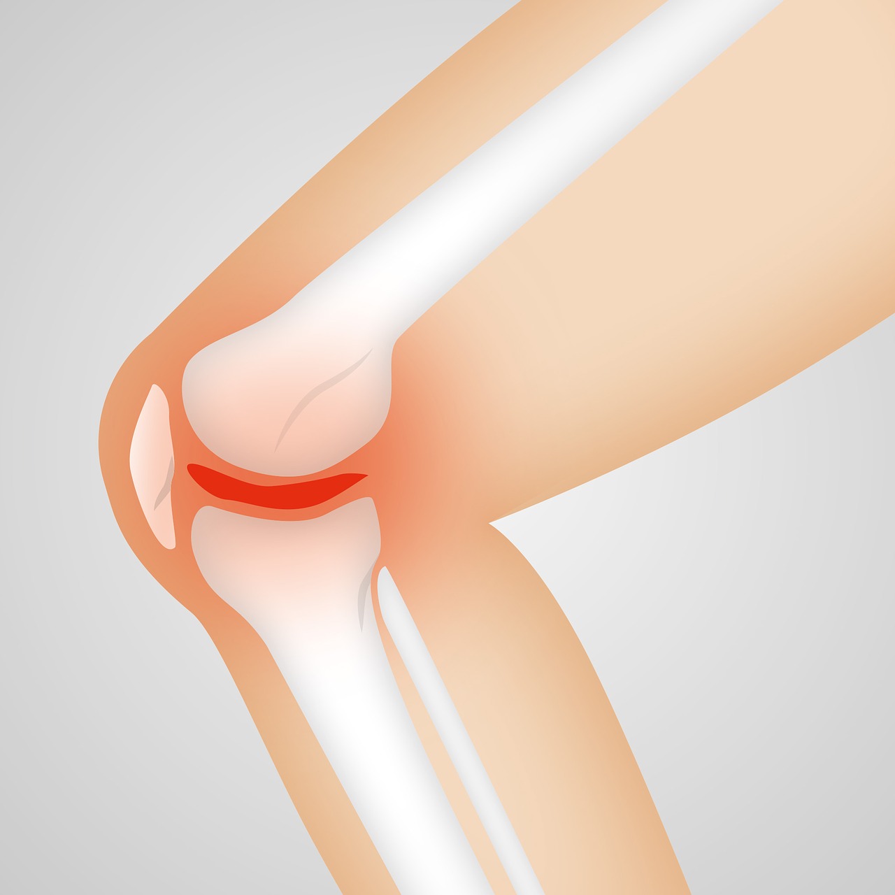arthrocalman osteoarthritis knee free photo
