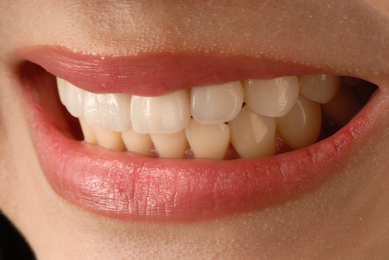asian smile  anterior teeth  veneer free photo