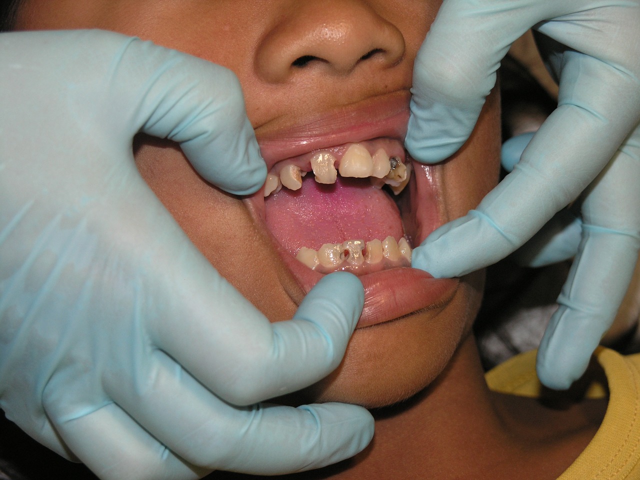 bad teeth toothache dental treatment free photo
