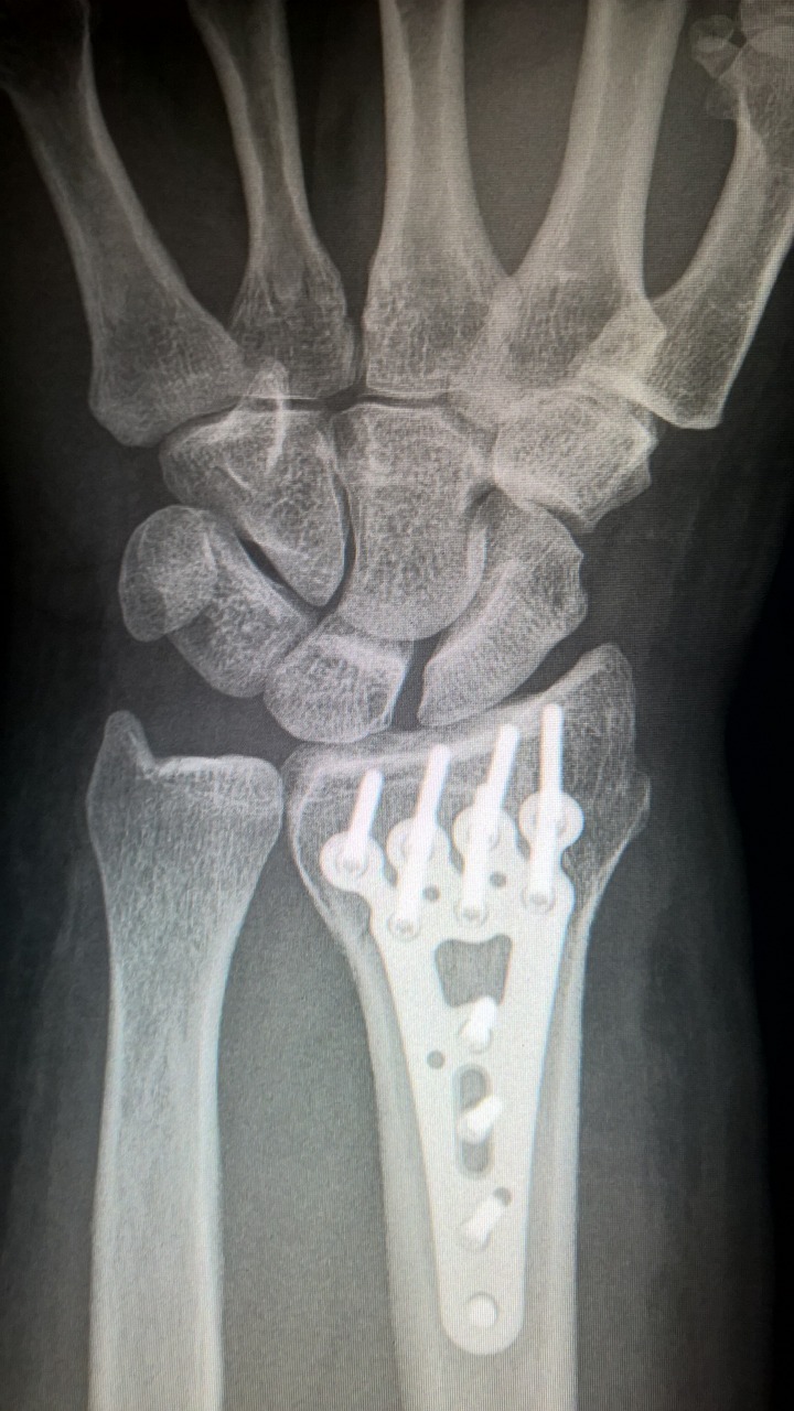 broken arm plate fixation titanium plate free photo