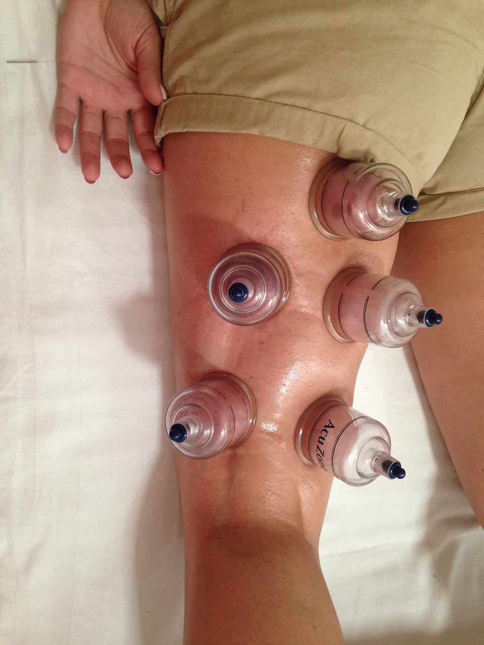 cupping acupuncture alternative free photo