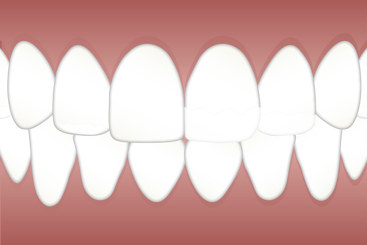 dental  fluorosis  mottled free photo