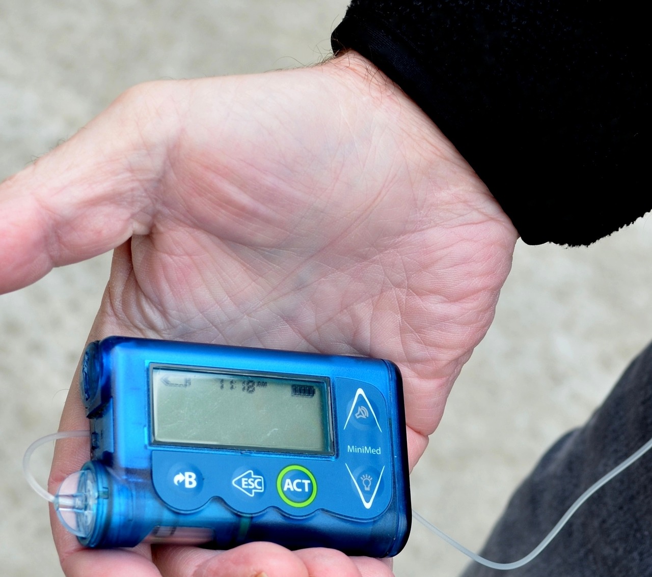 diabetes insulin pump free photo