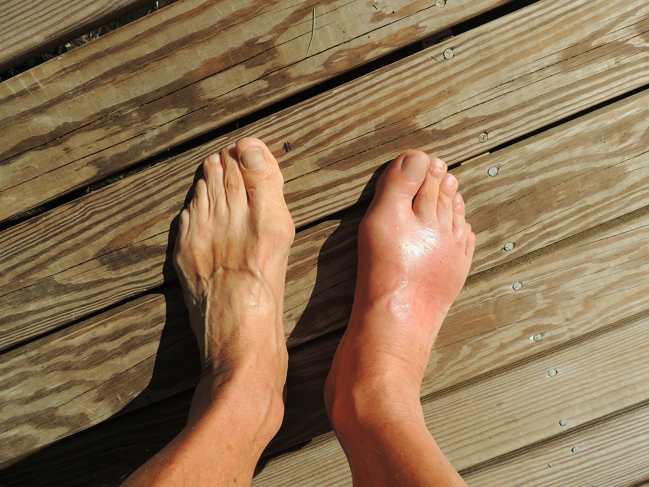 feet gout pain free photo