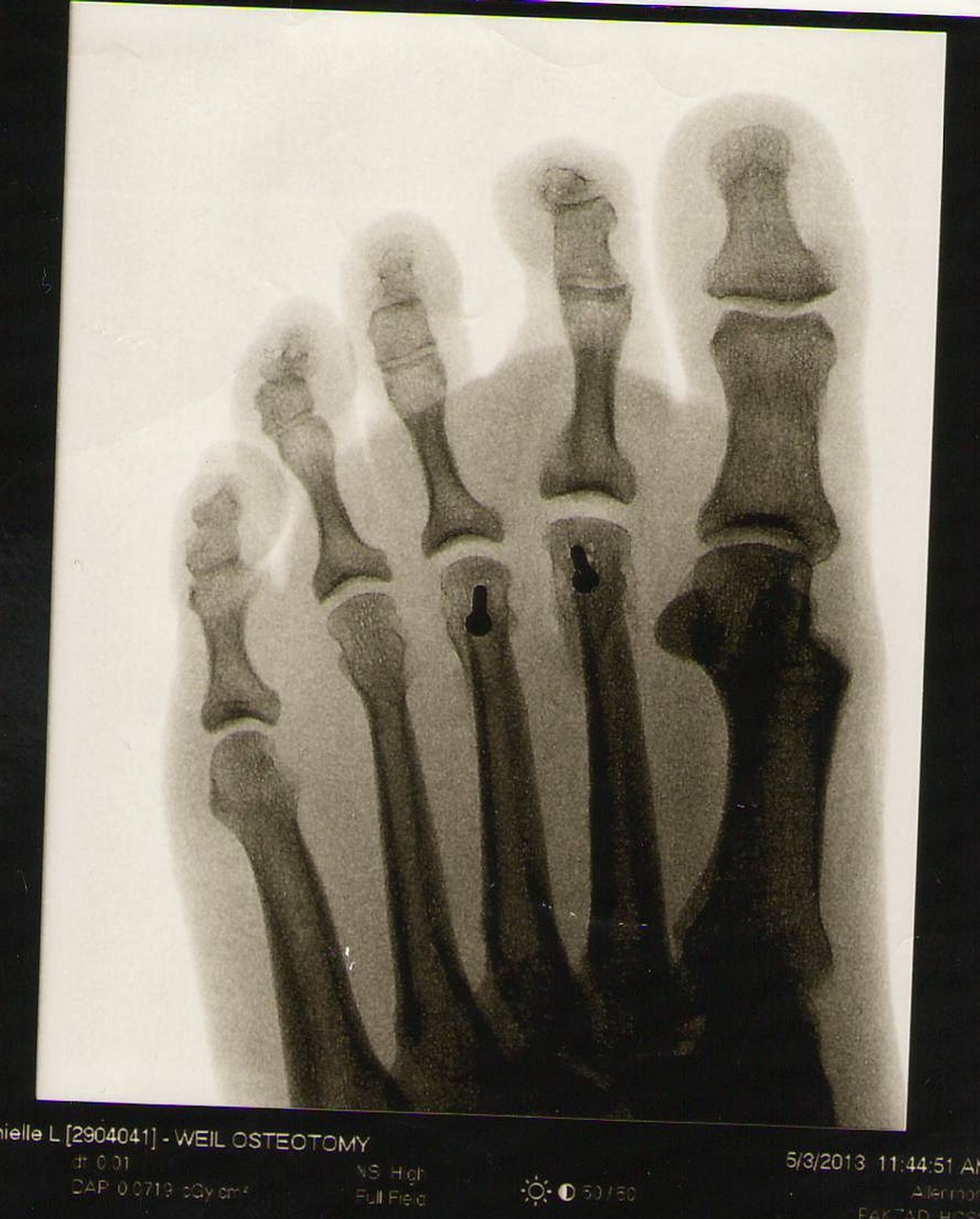 foot xray skeleton free photo