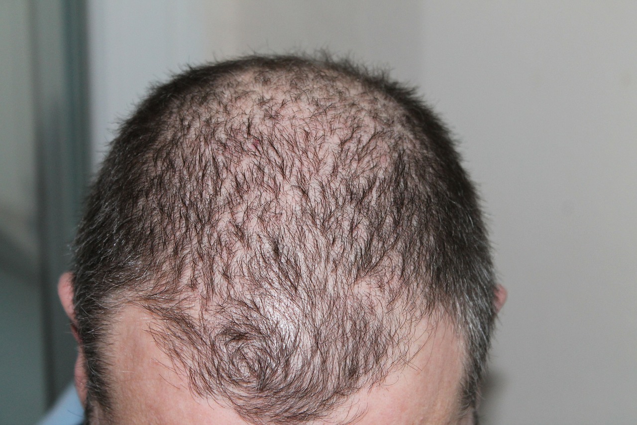hair man hair loss