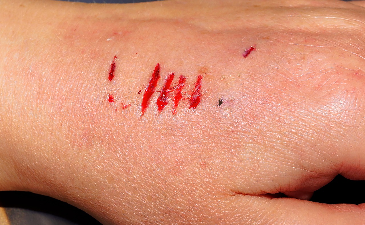 hand injury bite free photo