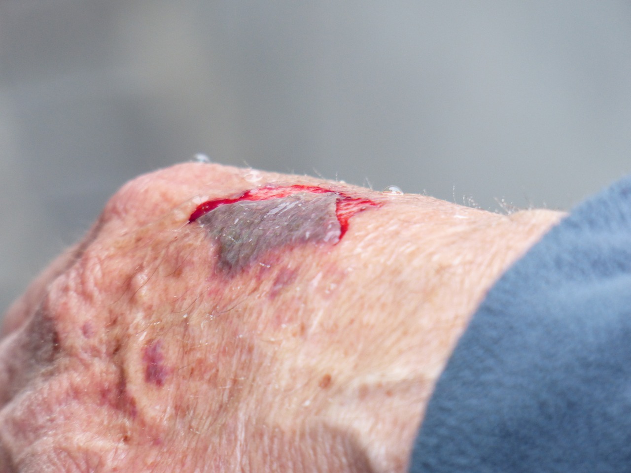 hand injury wound free photo
