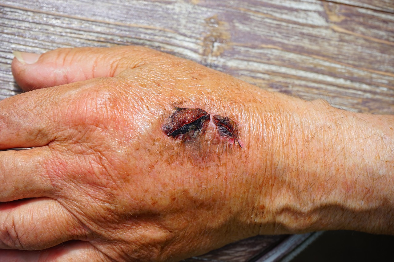 hand injury skin abrasion free photo