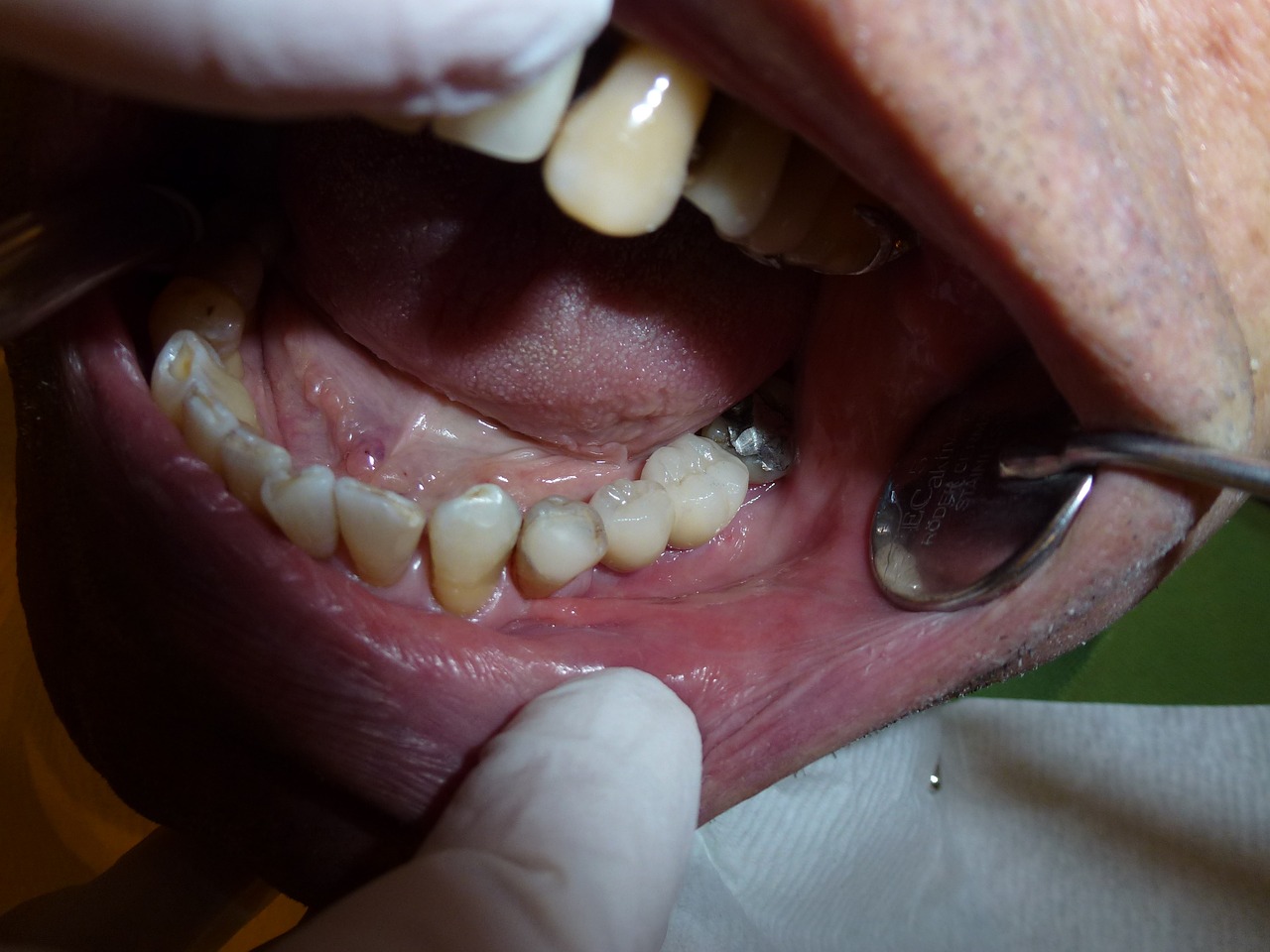 implant dentistry dentist free photo