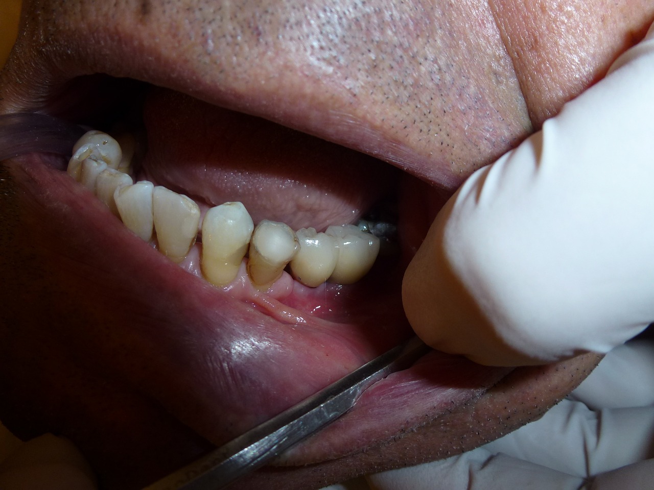 implant dentistry dentist free photo