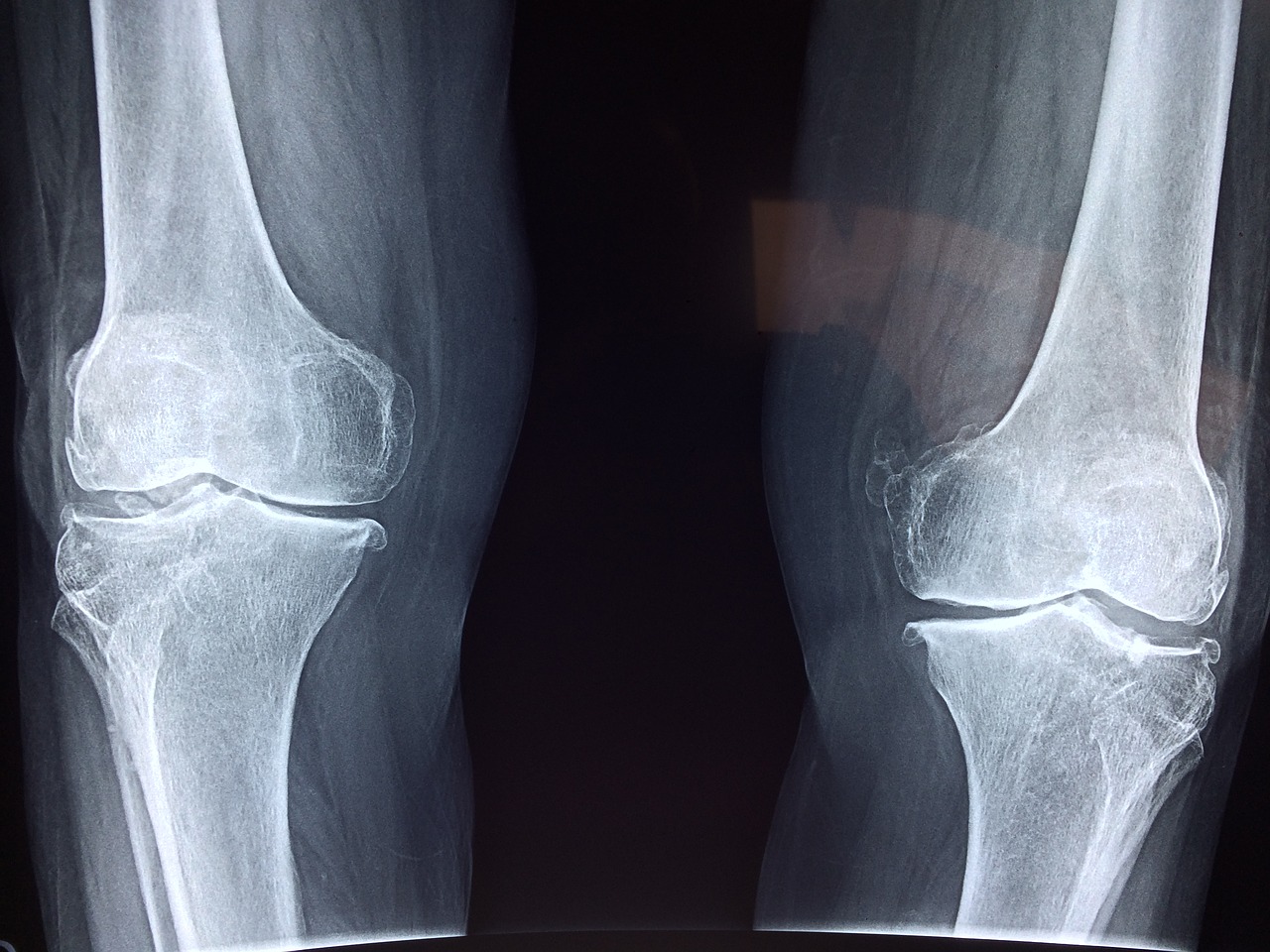 knee x-ray medical free photo