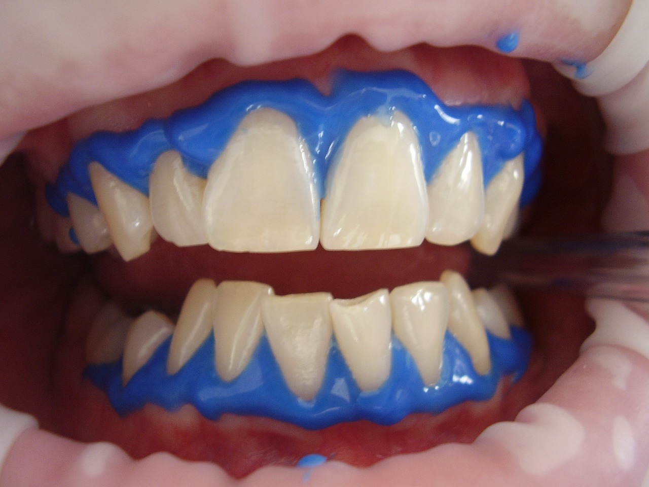 laser teeth whitening dental whitening free photo