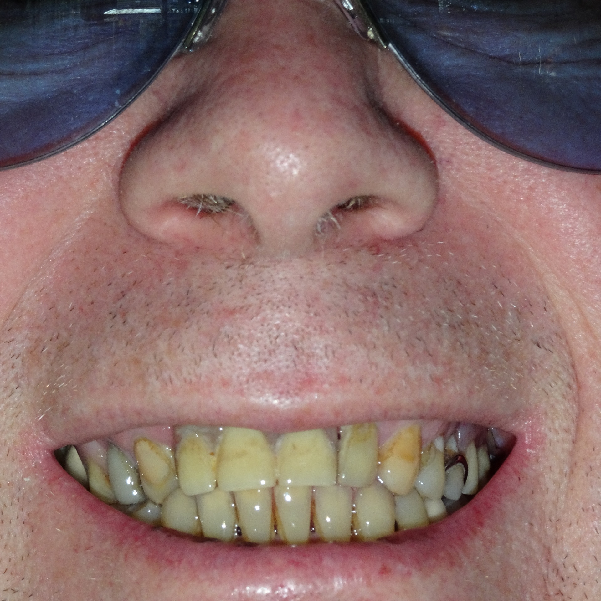 my yellow teeth free photo
