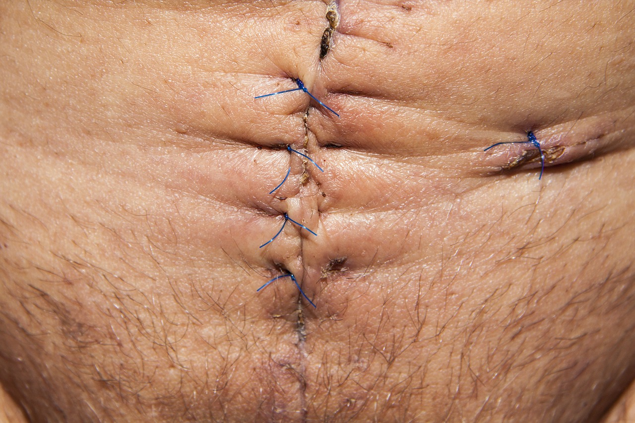 op operation abdomen surgery free photo