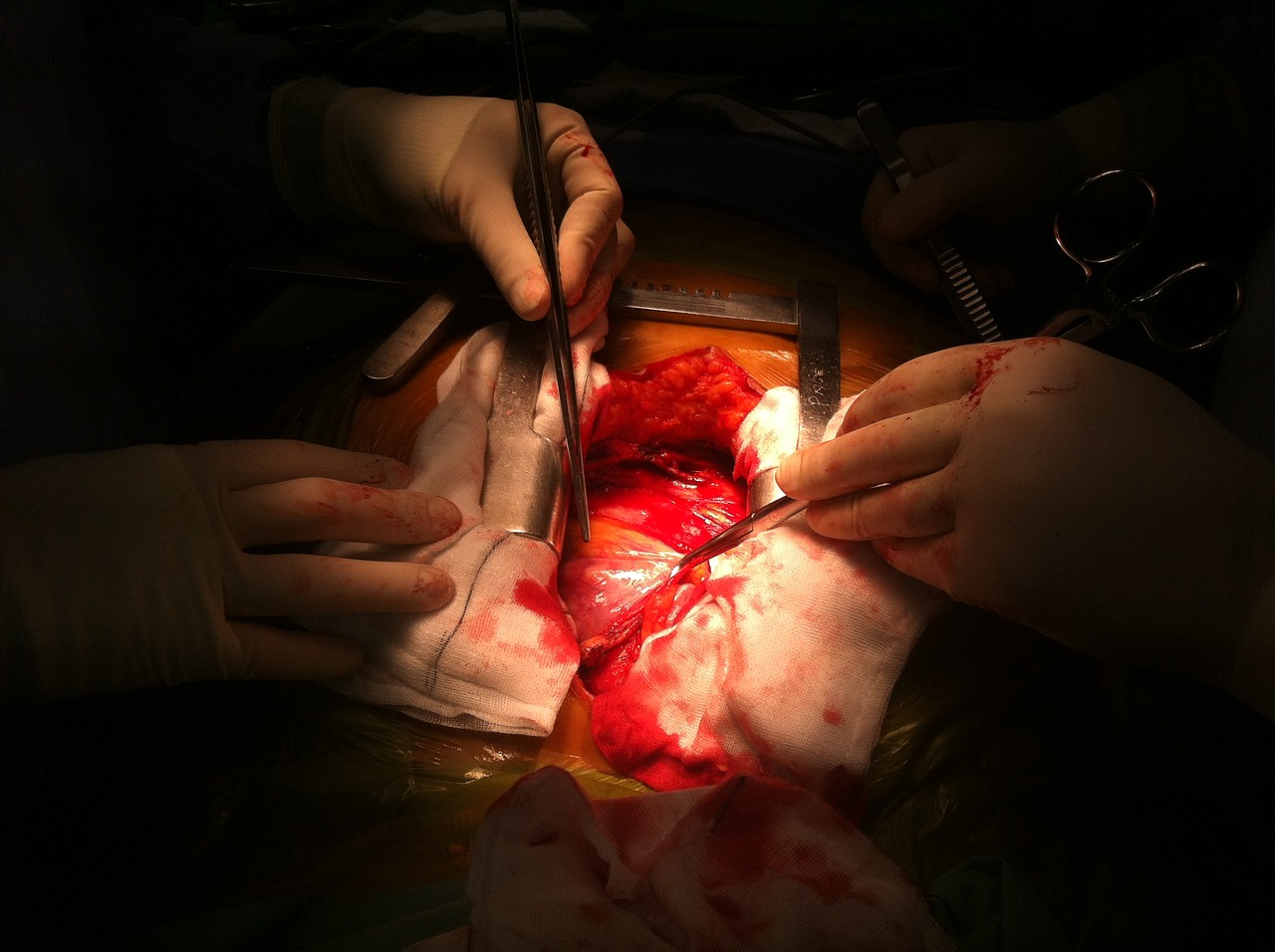 operation open heart free photo