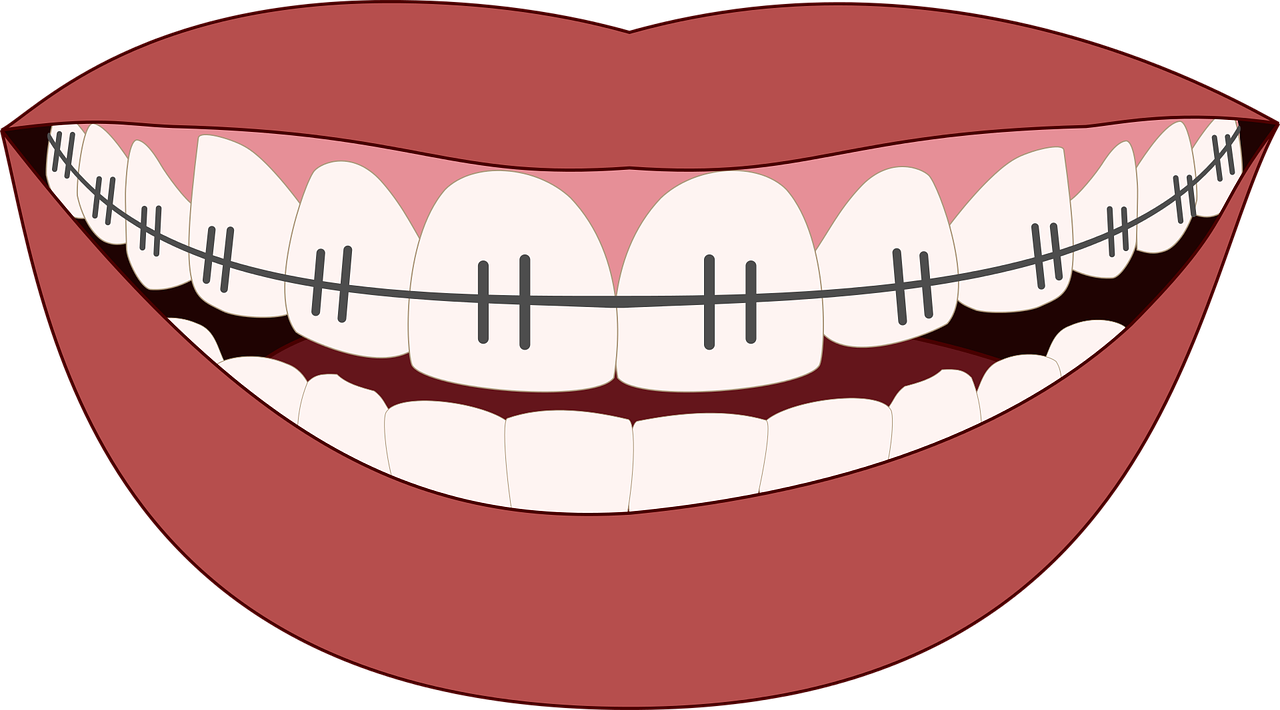 dental braces clipart free