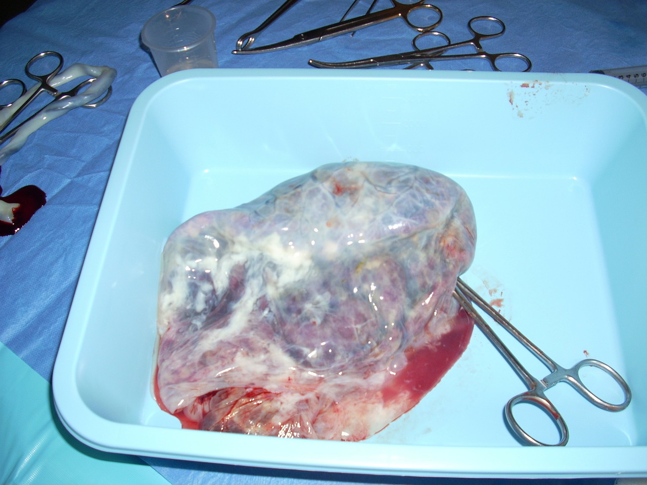 placenta umbilical cord birth free photo