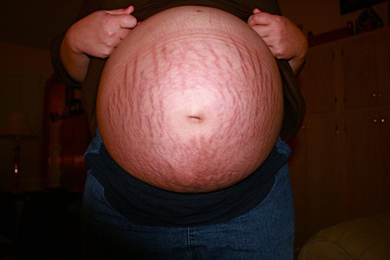 pregnant pregnancy stretch marks free photo