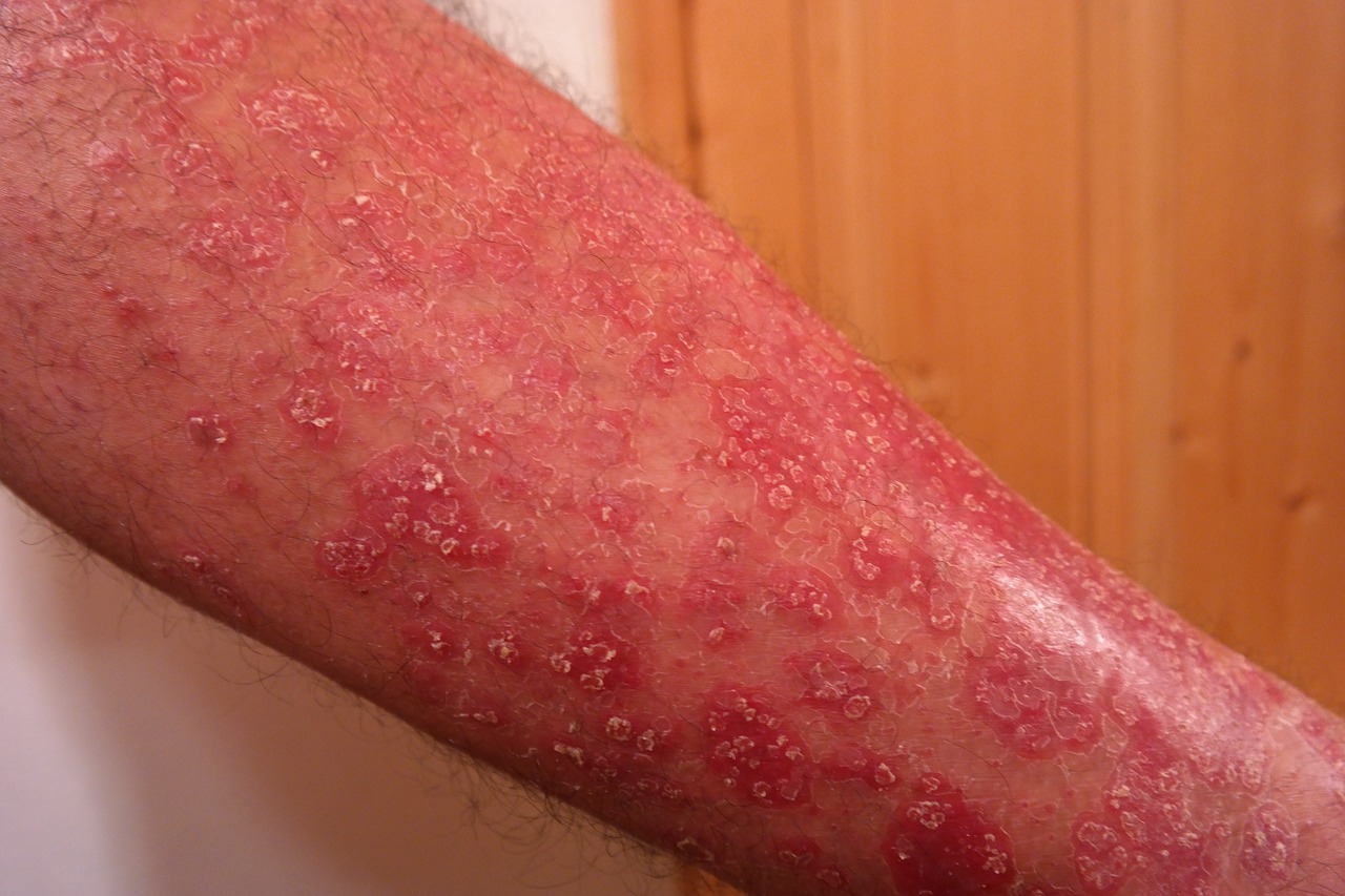 psoriasis skin disease red free photo