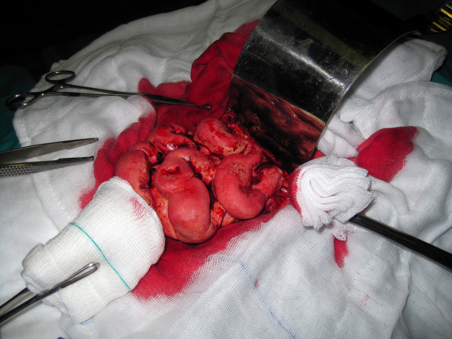 operation surgery abdominal free photo