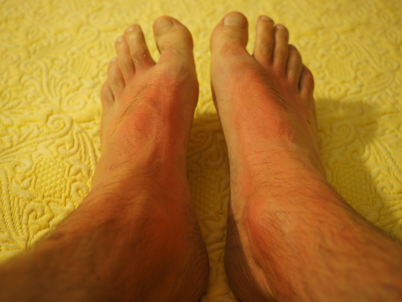sunburn feet skin free photo