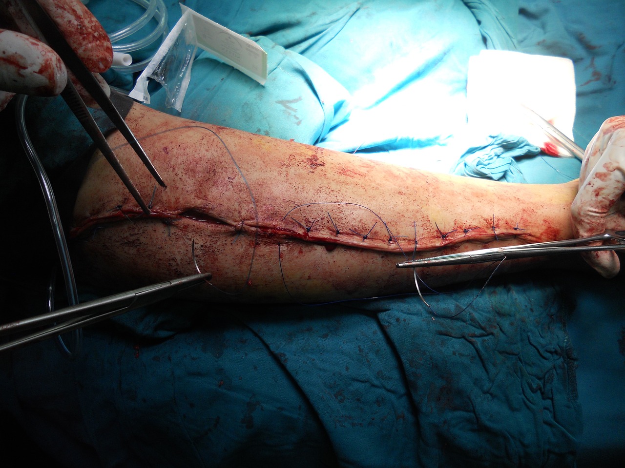 surgery orthopedic arm free photo