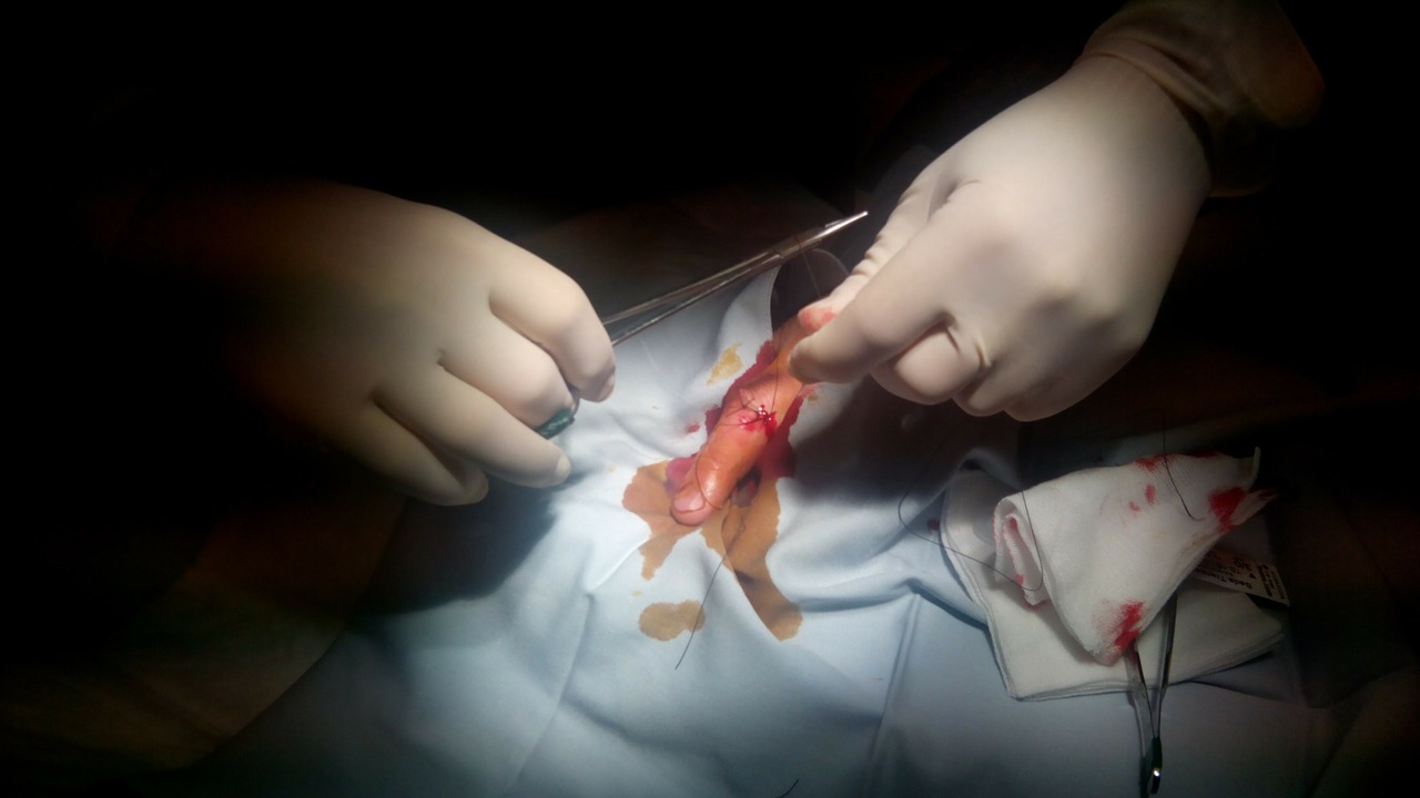 suture wound finger free photo