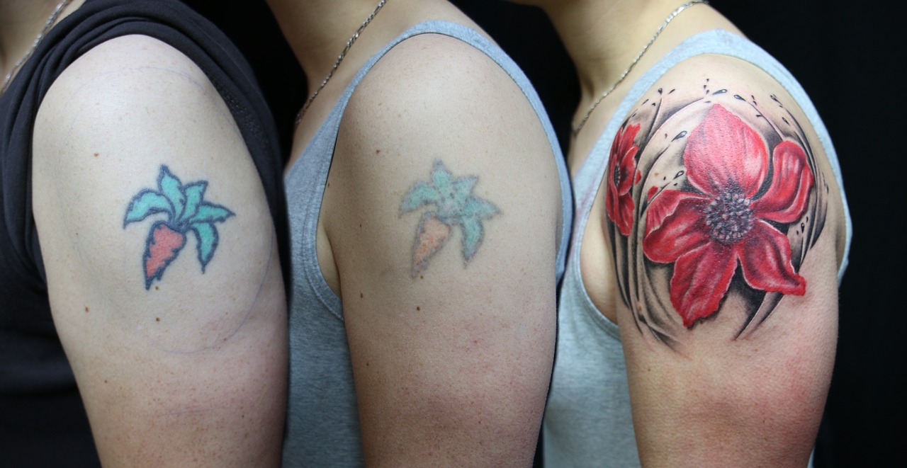 tattoo laser removal laser free photo