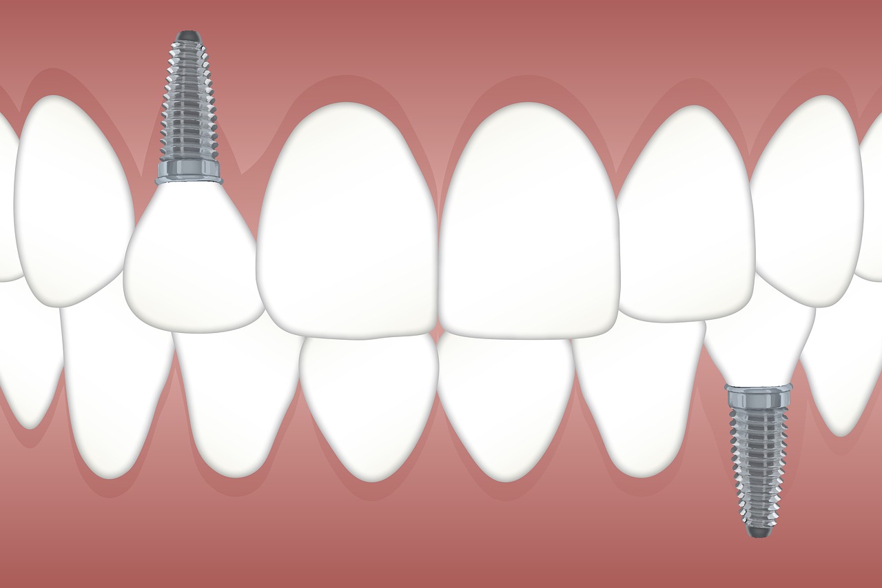 teeth  implant  orthodontics free photo