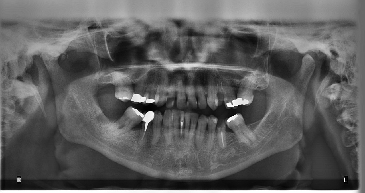 x-ray tooth radius free photo