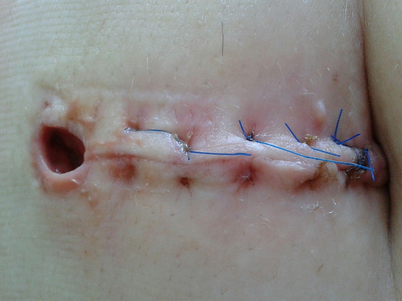 wound operation seam free photo