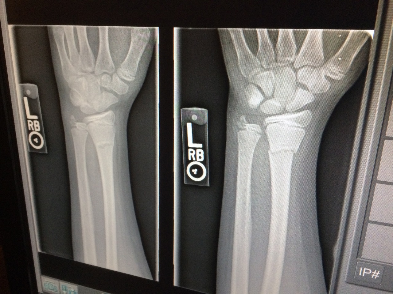 X-ray,medical,broken,arm,doctor - free image from needpix.com