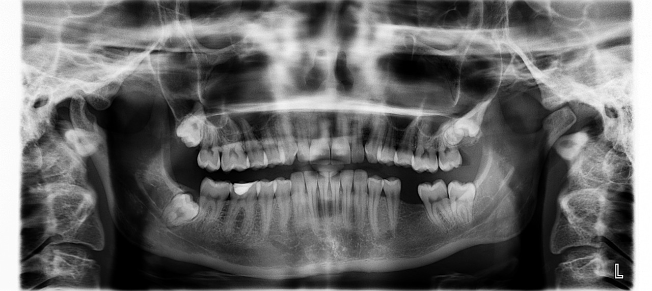 x ray teeth tooth missing free photo