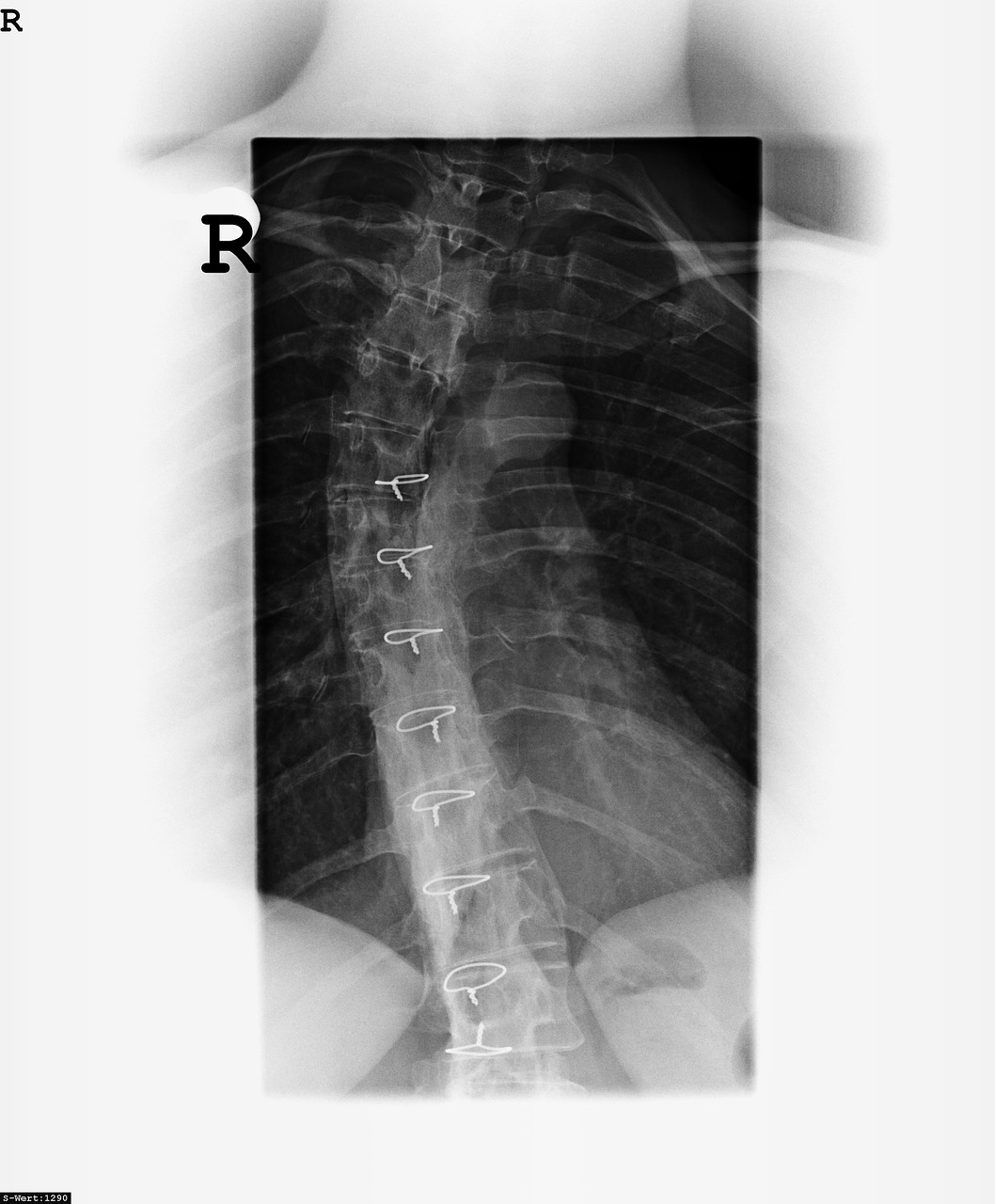 x ray image bone spine free photo