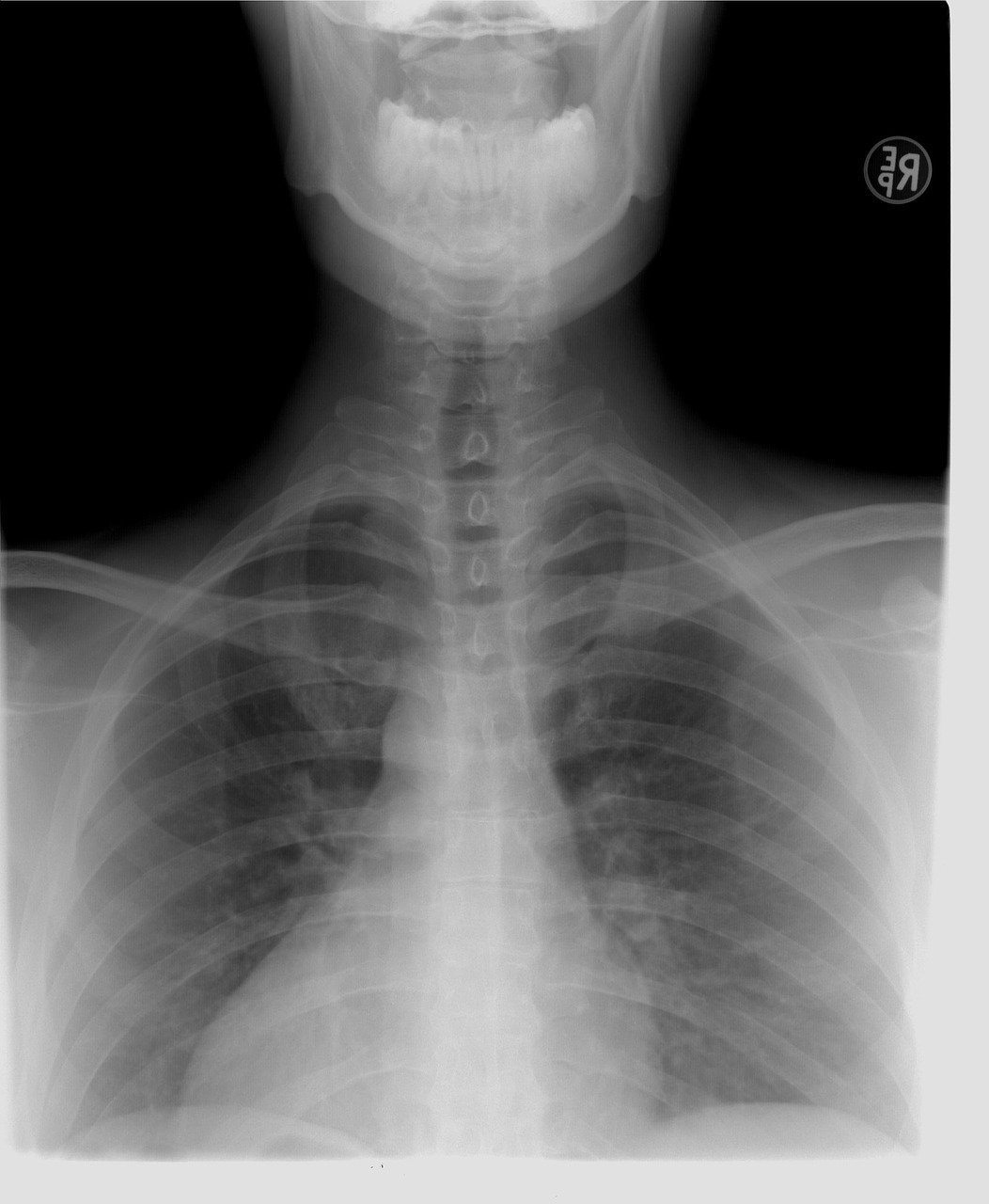xray thoracic spine diagnosis free photo