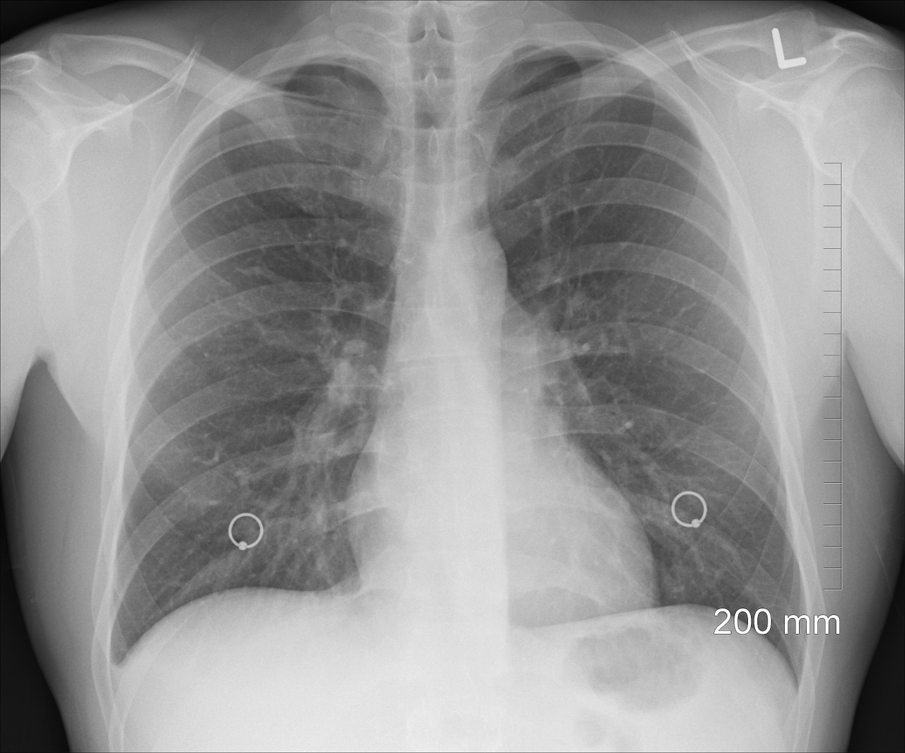 diagnosis xray chest free photo