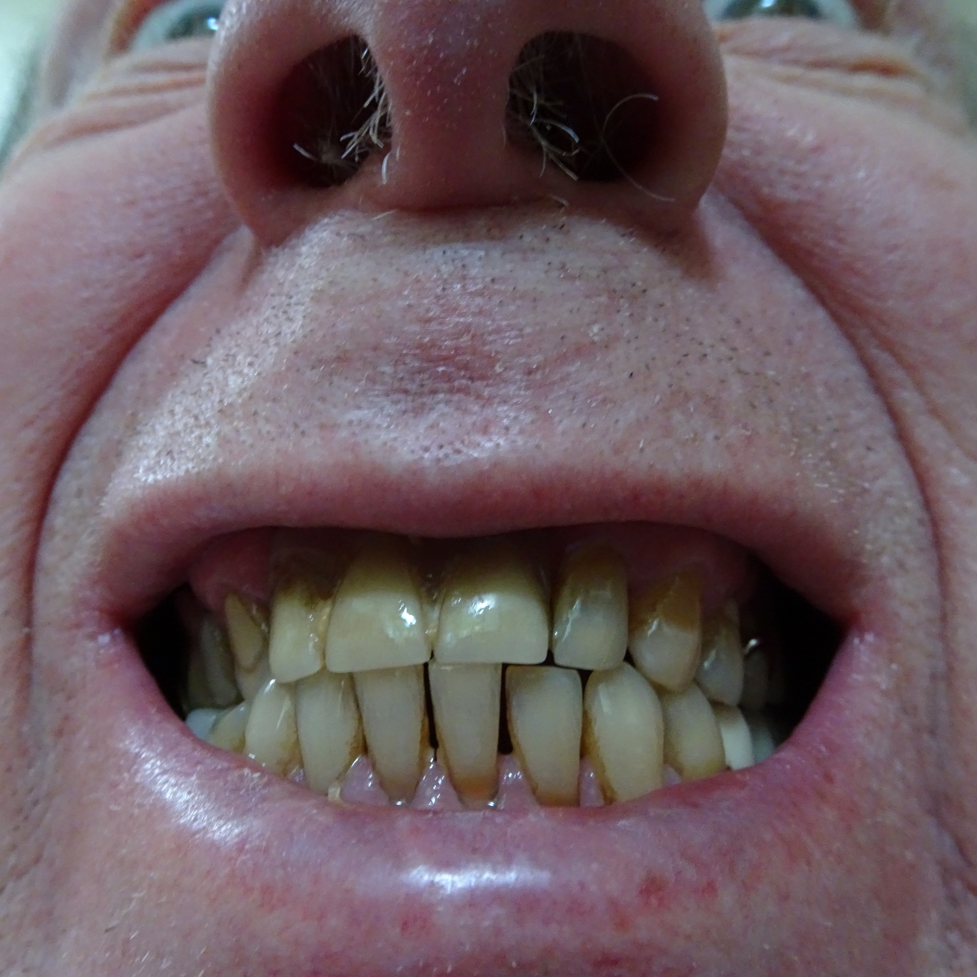 yellow teeth dentist free photo