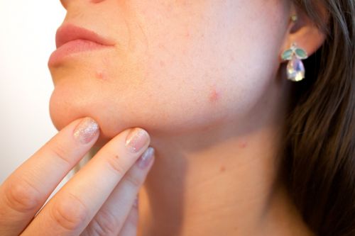 acne pores skin