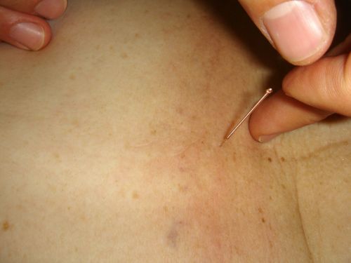 acupuncture needle acupuncture needle