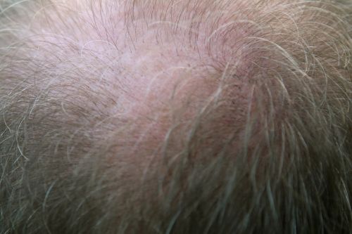 adult bald balding