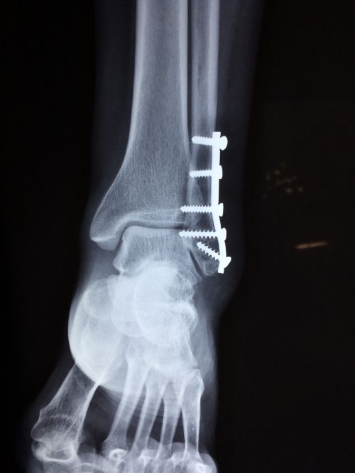 ankle fracture foot