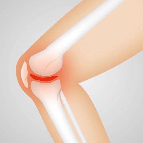 arthrocalman osteoarthritis knee